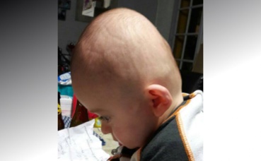 Romain atteint de brachycéphalie. Photo d'archives personnelles (c) Kelly Macquet Romain atteint de brachycéphalie. Photo d'archives personnelles (c) Kelly Macquet