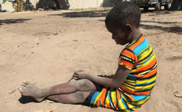 "La malnutrition constitue une menace silencieuse pour des millions d’enfants". Image du domaine publique.