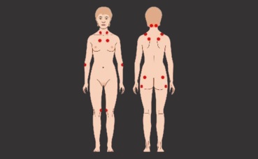 Fibromyalgie. Image du domaine public. Fibromyalgie. Image du domaine public.