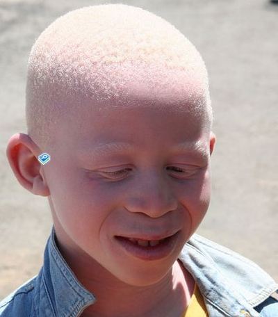 Image représentant un homme atteint d'albinisme total. Photo (c) Muntuwandi