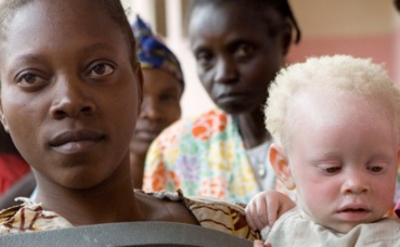 Une jeune femme tient dans ses bras son enfant atteint d'albinisme. Photo (c) Marie Frenchon / ONU