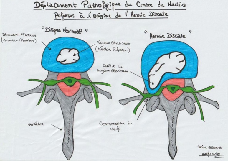 Déplacement pathologique du centre du nucléus pulposus à l'origine de la hernie discale – Schéma issu d'un cours d'anatomie du rachis – IFRES de Normandie-Alençon © Marine B.