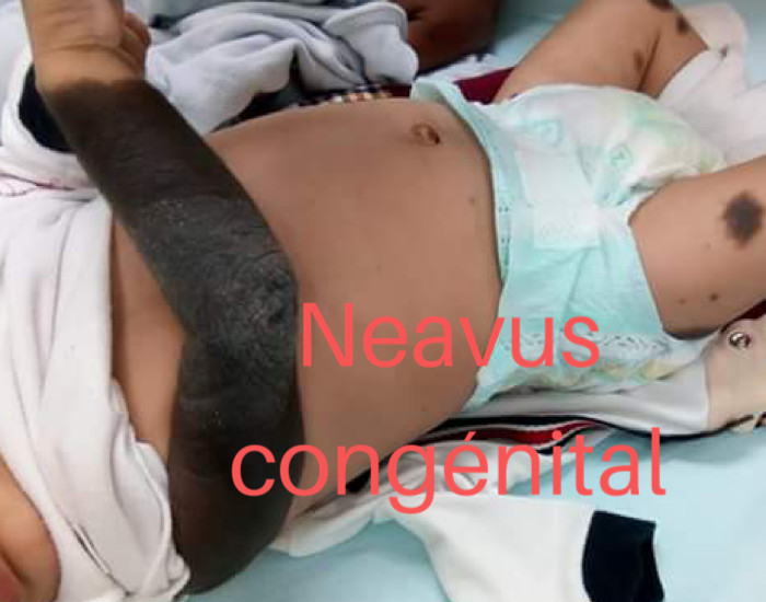 Le Naevus congénital apparaît dès la naissance jusqu’à l’âge de 2 ans. (c) Mohammad 2018, Wikimedia Commos.