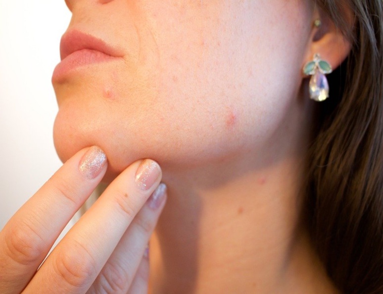 Pour l'utiliser dans le traitement d'une peau acnéique, il faut appliquer quelques gouttes le matin et le soir sur une peau propre et démaquillée (C) Kjerstin Michaela
