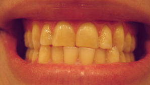 Image du domaine public. Cliquez ici pour obtenir des produits anti-bruxisme Image du domaine public. Cliquez ici pour obtenir des produits anti-bruxisme