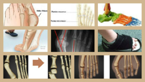 Hallux valgus. Illustrations (c) WIM Hallux valgus. Illustrations (c) WIM