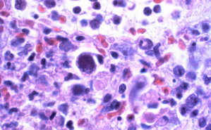 Le CMV, un virus pas toujours inoffensif. Photo (c) Yale Rosen Le CMV, un virus pas toujours inoffensif. Photo (c) Yale Rosen