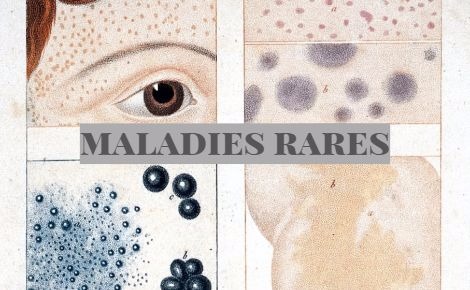 Maladies Rares De nouveaux centres labellisés maladies rares