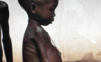 L'IMAGE DU JOUR: Fillette atteinte de kwashiorkor