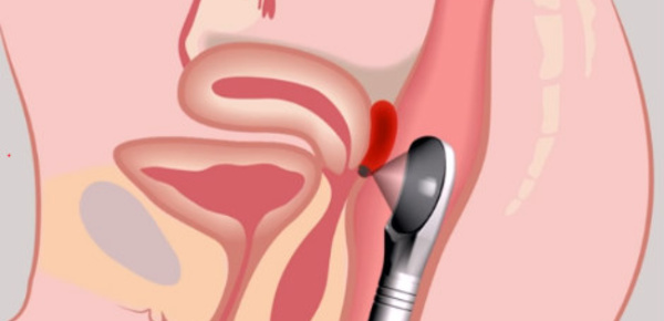 Endométriose: vers la fin d'un mal féminin?