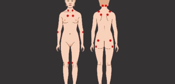 En savoir plus sur la fibromyalgie