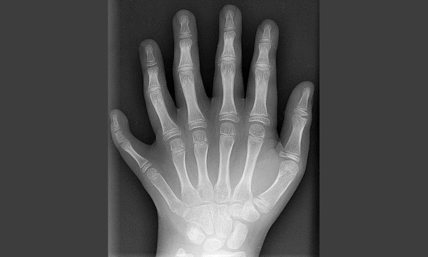 L'IMAGE DU JOUR: Polydactylie