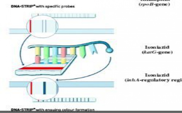 La tuberculose, ne meurt pas. Les nouvelles actions de lutte de l’OMS