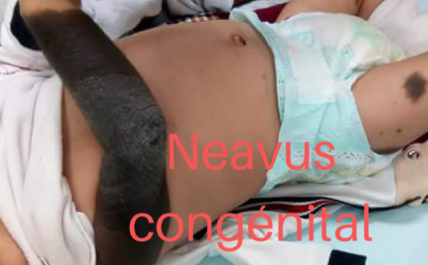 Lumière sur le Neavus congénital