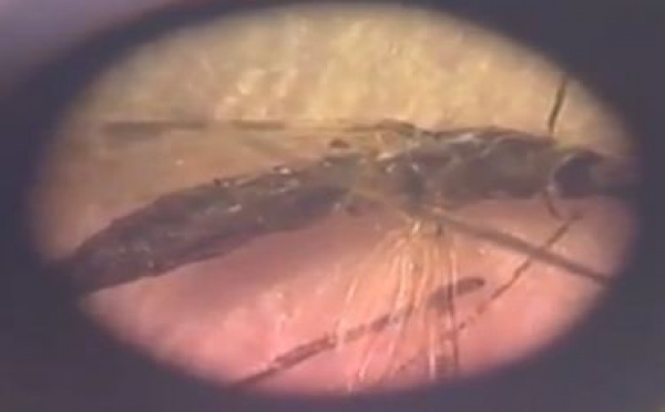 Le paludisme dans le monde