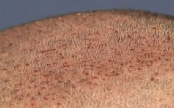 Que signifie le micro-greffon et comment se déroule une greffe de cheveux?