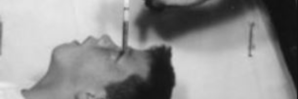 Le retour des lobotomies 