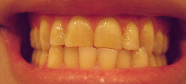 Le grincement de dents