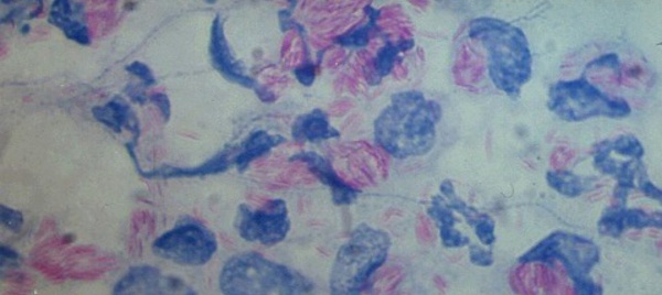 La lèpre n'appartient pas au Moyen-Âge