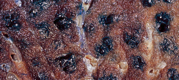 Héréditaire, génétique, viral? Le cancer fait toujours peur