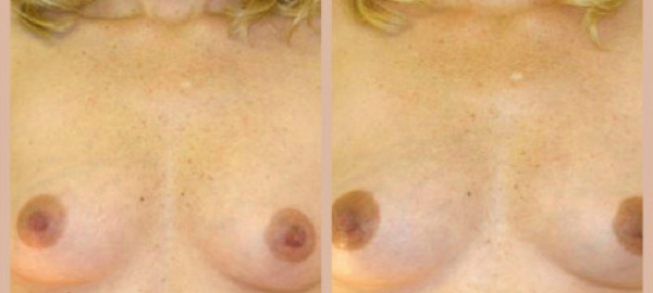 Modifications cutanées de la grossesse