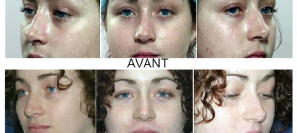 Modifier le nez sans chirurgie