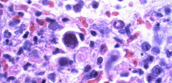 Femmes enceintes: attention au CMV!