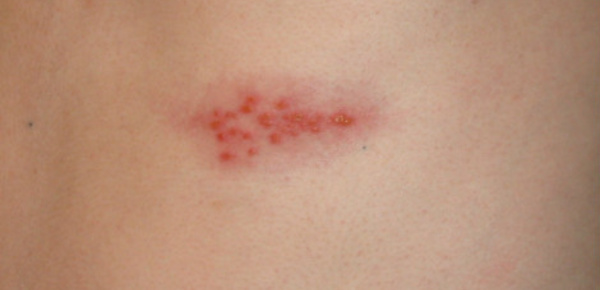 Nouveaux espoirs dans la prise en charge du zona